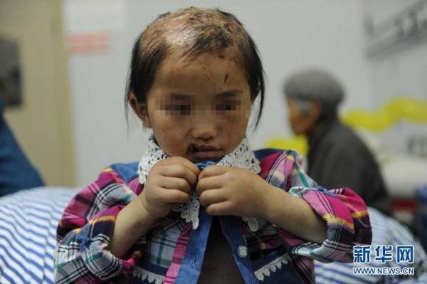 china-guizhou-little-girl-abused-by-father-burned-head-boiling-water-b-600x399